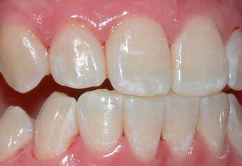 Você sabe o que é fluorose dentária? Compreenda sobre essa condição que pode ser prejudicial ao seu filho