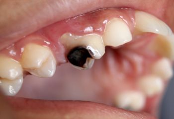 O que a Cárie Dentária faz com o dente? Compreenda todo o processo de maneira simples: