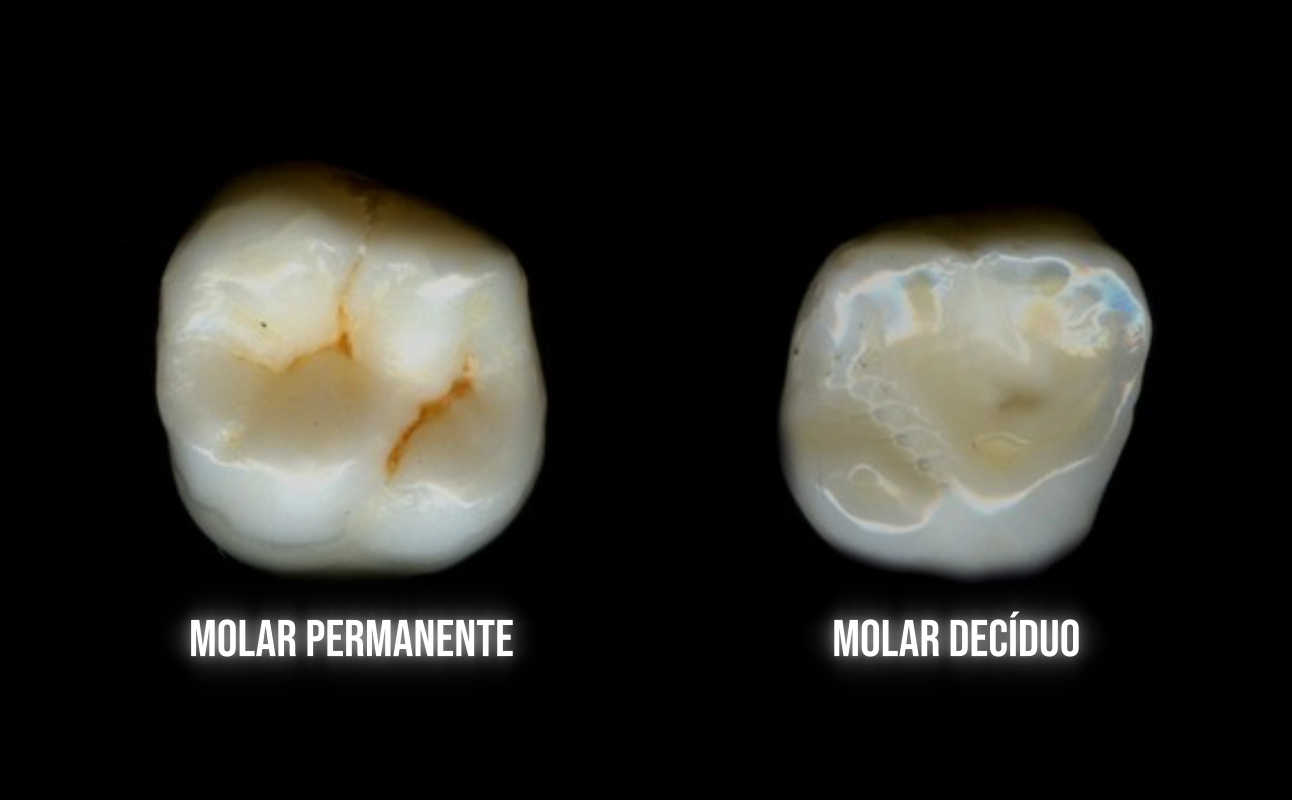 molar decíduo e molar permanente anatomia oclusal