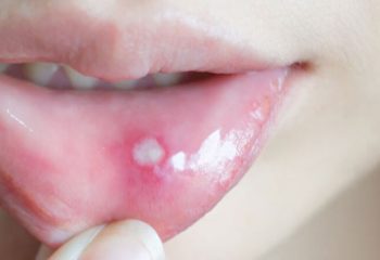 Conheça as lesões e ocasionalidades mais importantes que podem aparecer na boca de seu filho