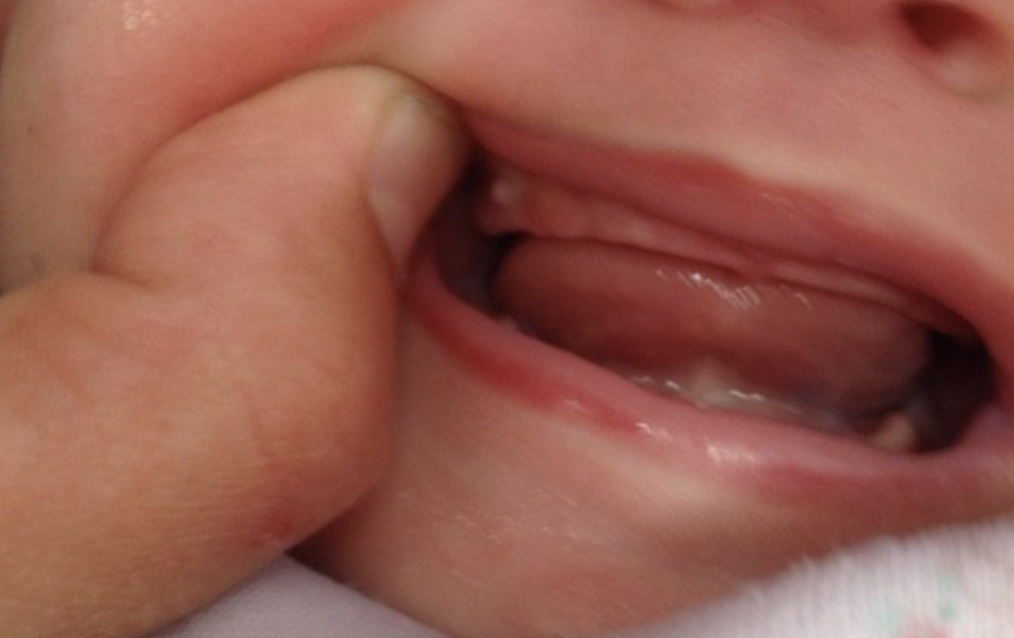 Pérolas de Epstein do recém-nascido: causas, sintomas e tratamento -  Dentalis