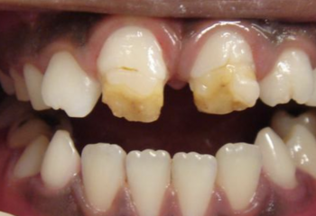 Hipomineralização Molar-Incisivo e Hipoplasia de Esmalte: Anomalias dentárias que precisam de atenção redobrada